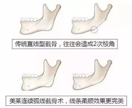 方脸妹纸做完下颌角