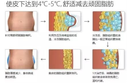 吸脂减肥