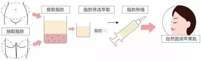 苹果肌脂肪填充