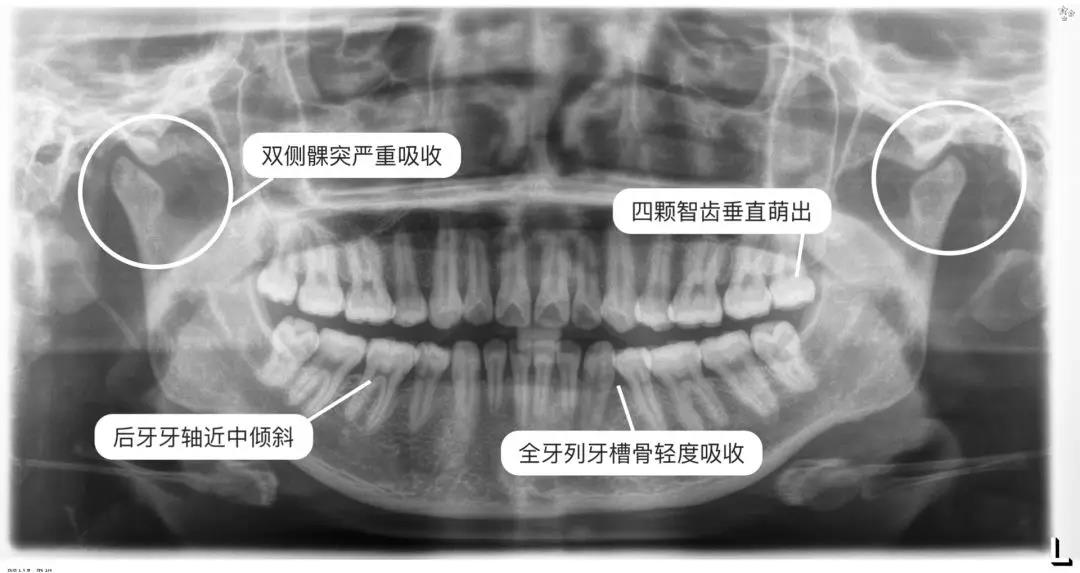 牙齿矫正