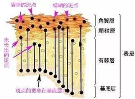 净斑雪花针