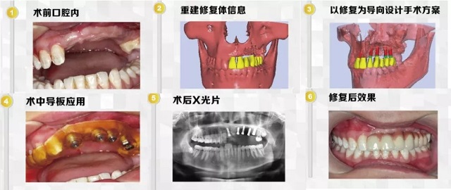 美莱数字化微创种植