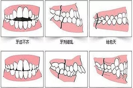 牙齿矫正的优点是什么