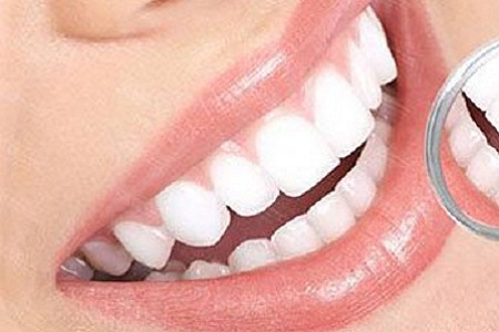 牙齿嵌体修复术