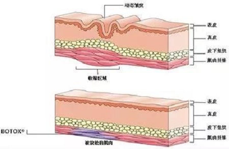 注射玻尿酸和玻尿酸