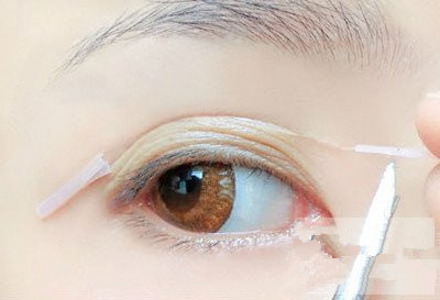 微创双眼皮手术要多少钱？