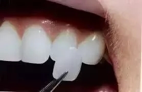 牙齿美白