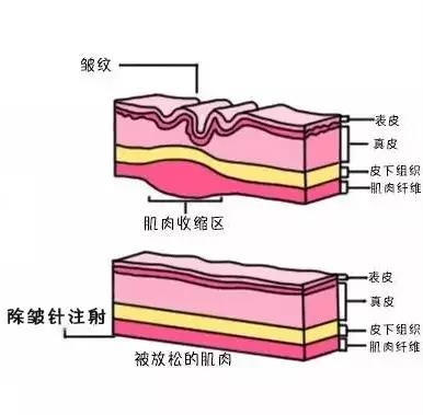 除皱针