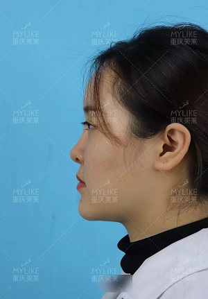 “鼻综合”后假又歪，还挛缩？鼻修复还原自然生态美鼻