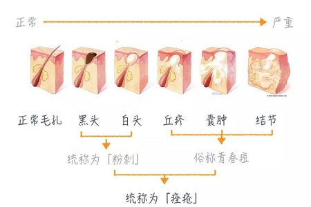 挤痘竟然被送进ICU！你的痘痘还好吗？