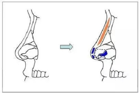 担心鼻整形假体透光、发红、移位？了解下自体软骨