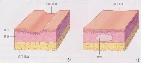 自体脂肪填充为什么需要二次补打？