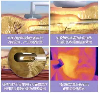 Bodytite黄金微雕：比吸脂更好的瘦身利器