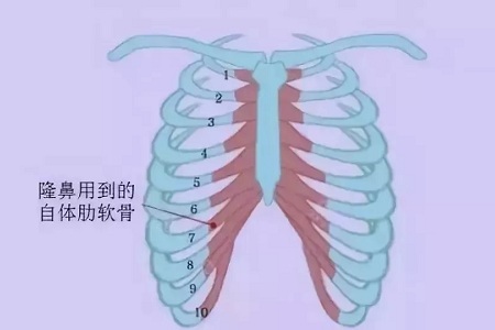 什么，隆鼻方式竟然有这么多种？