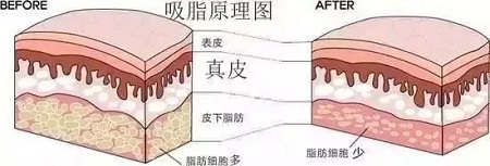 医美白皮书：吸脂等于减肥吗？