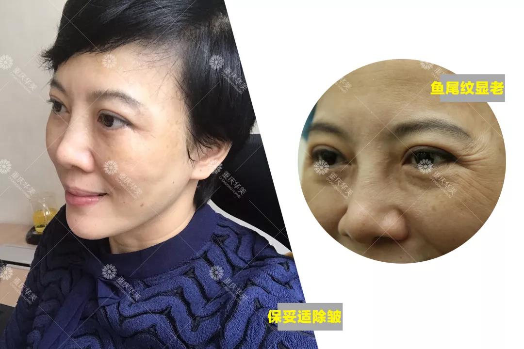 如果你是这种脸型，打瘦脸针一定有用！