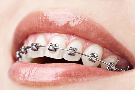 医美白皮书：被透明牙套拯救的钢牙妹们