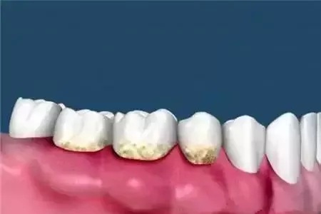 问诊室：为什么我的牙却永远也刷不白？