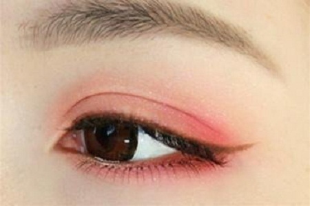 韩式微创双眼皮手术