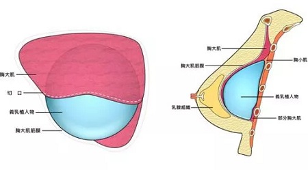 【涨知识】 解读你较关心的假体隆胸问题!