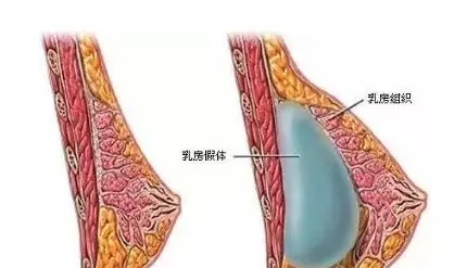 自体脂肪or假体隆胸，我到底应该怎么选？