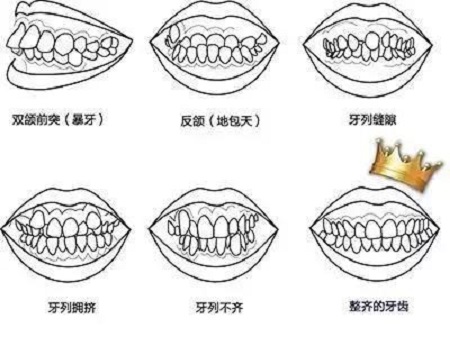 矫正牙齿