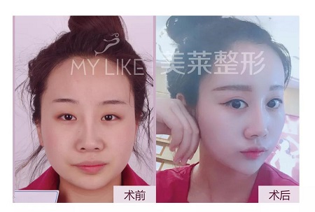 双眼皮