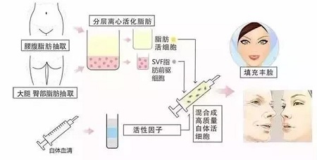 自体脂肪填充