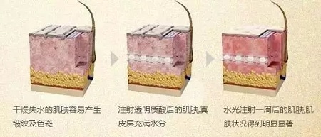 水光，打1次和4次究竟有多大区别？