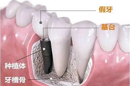 美莱牙齿矫正，让你吃的香吃的好重享美味