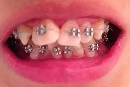 这种牙齿矫正方式，96%的人都会选择！