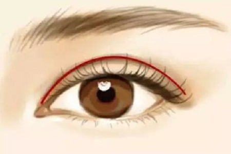 问诊室：做完双眼皮眼睛真的会变大吗？