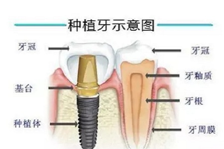 揭秘牙齿矫正的全过程！！！