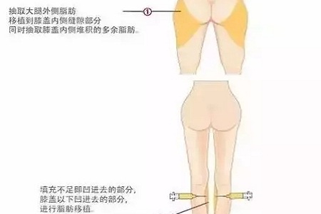 问诊室：你说脂肪压得你好累，殊不知它也可以是宝贝