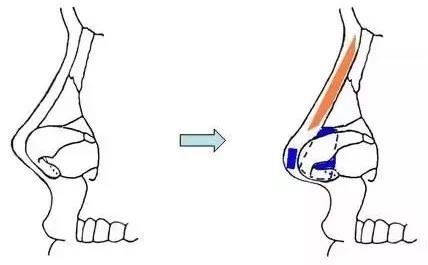 耳软骨隆鼻过程图