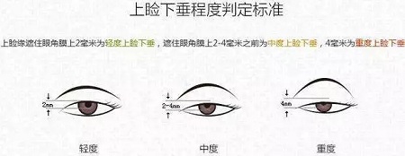 据说80%的亚洲女性都有这一眼部通病，上睑下垂你了解过吗？