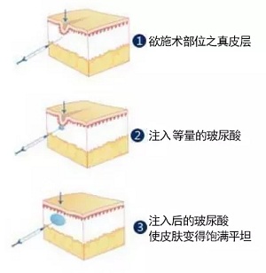 用玻尿酸治疗鼻唇沟，一定要注意这种情况！