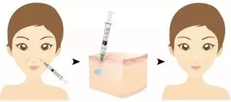 用玻尿酸治疗鼻唇沟，一定要注意这种情况！