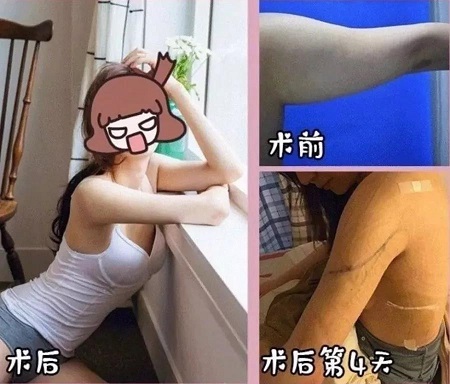 吸脂手术