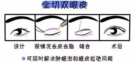 美眼张诚坐诊美莱，浅谈为什么你的眼睛不够美？