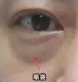 暂时性眼袋