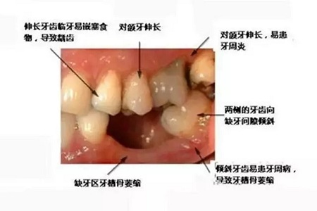 牙齿缺失时，选烤瓷牙还是那种？