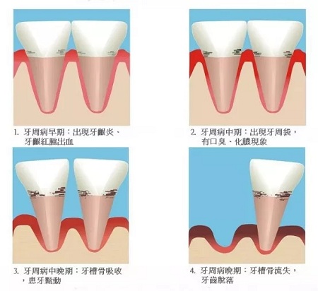 牙齿缺失时，选烤瓷牙还是那种？