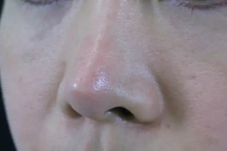 假体隆鼻手术