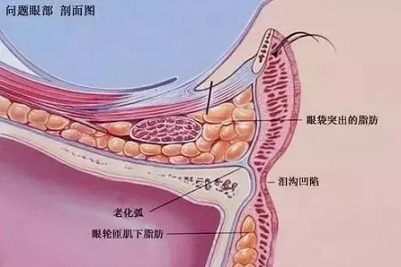 眼袋泪沟怎样同时祛除