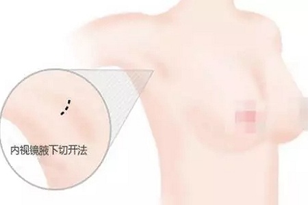 假体隆胸的三种切口应该怎样选择
