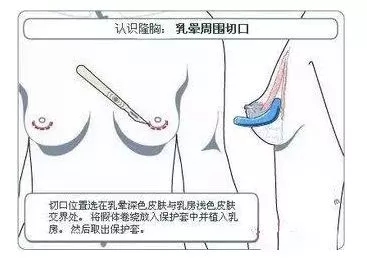 假体隆胸的三种切口应该怎样选择