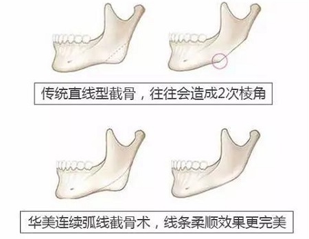 改脸型