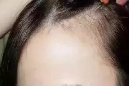 头发种植