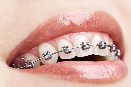 牙齿出现哪些情况需要进行矫正